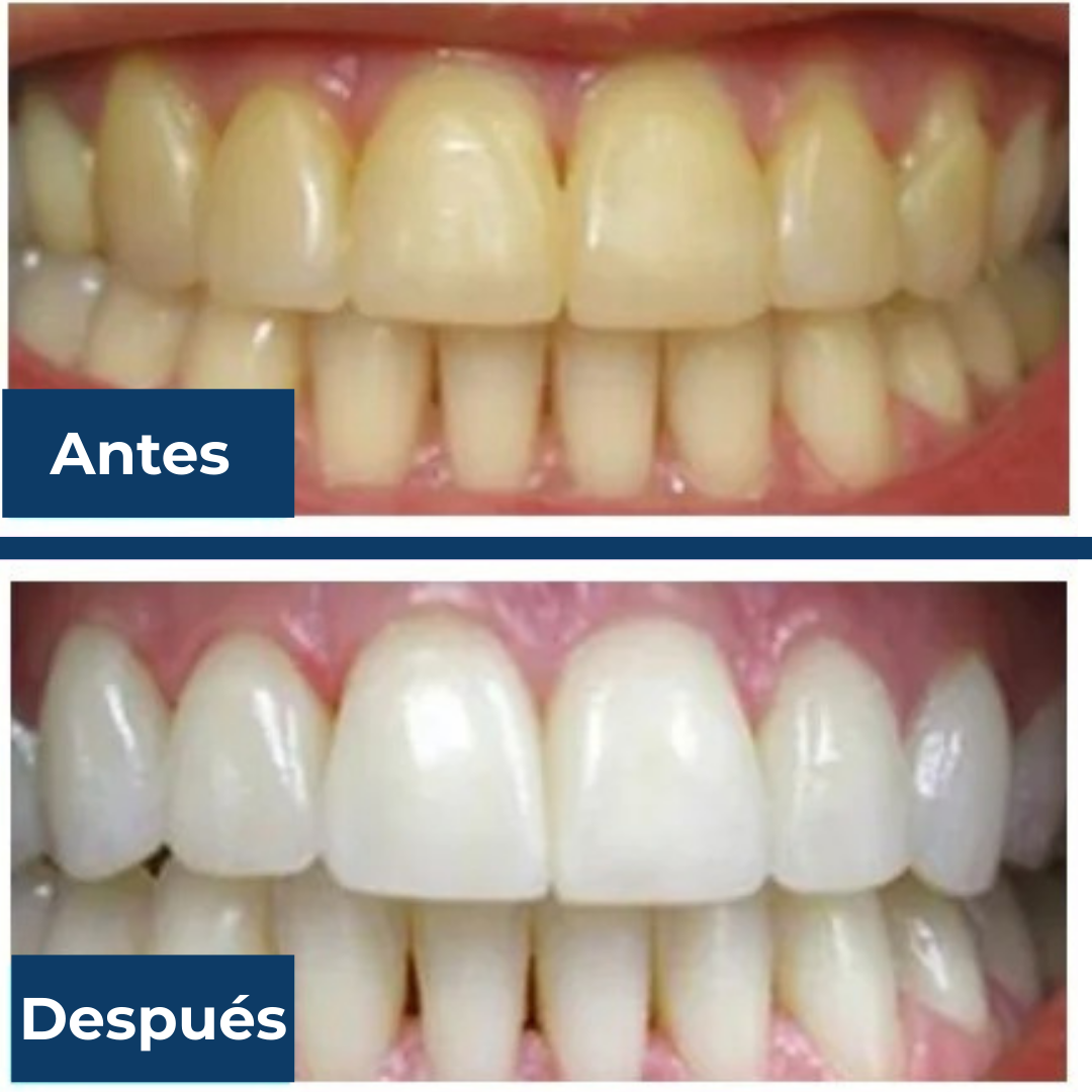 MyCureDerm® OralWhite LED Kit  Sistema de blanqueamiento dental con luz LED – Fórmula suave