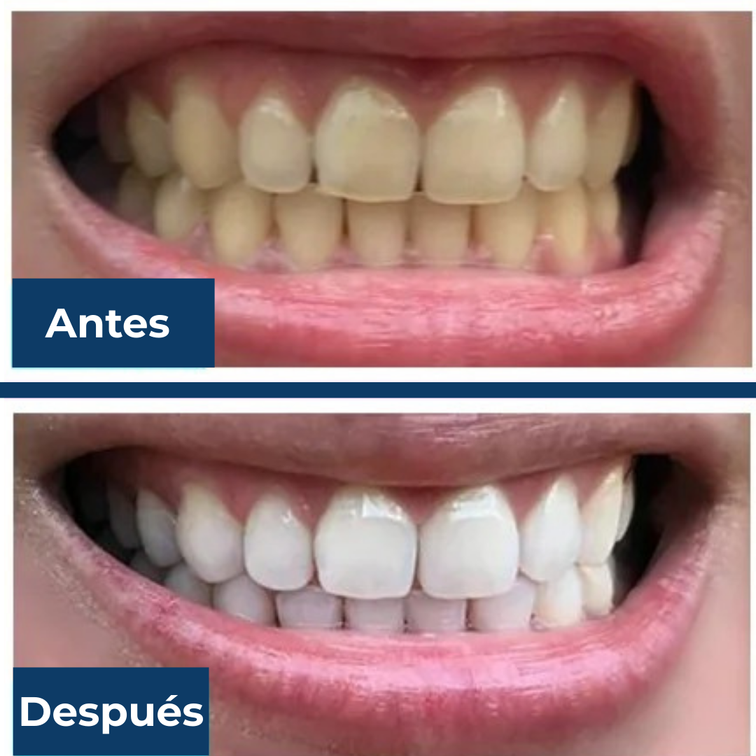 MyCureDerm® OralWhite LED Kit  Sistema de blanqueamiento dental con luz LED – Fórmula suave