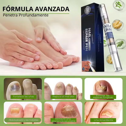 MyCureDerm Lápiz Antifúngico con Fórmula Avanzada – Contra Pie de Atleta y Hongos en Uñas