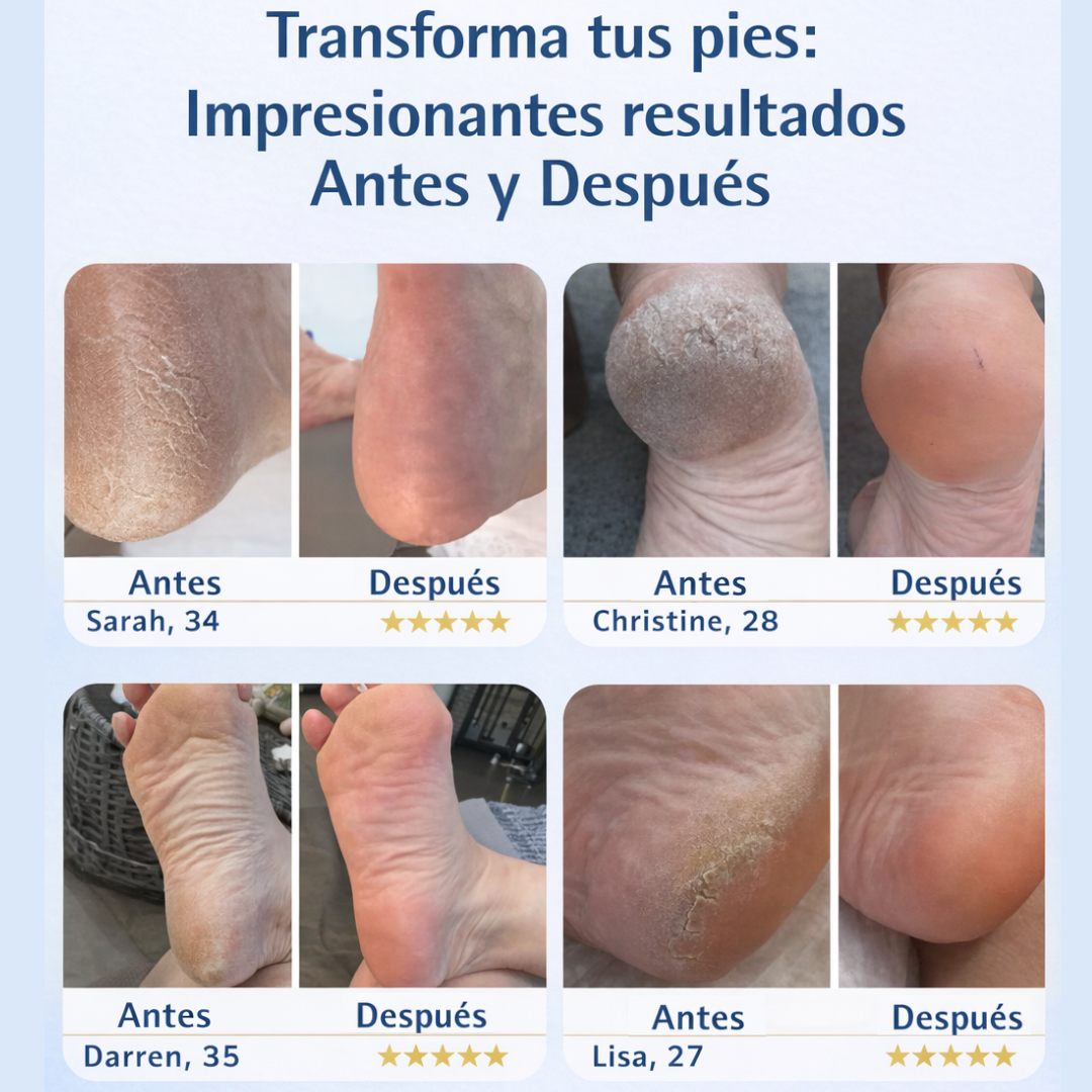 MyCure™ 2 Pro – Eliminador Profesional de Callos