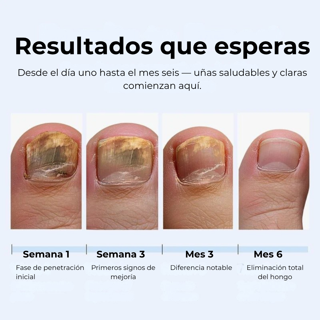 MyCureDerm Lápiz Antifúngico con Fórmula Avanzada – Contra Pie de Atleta y Hongos en Uñas