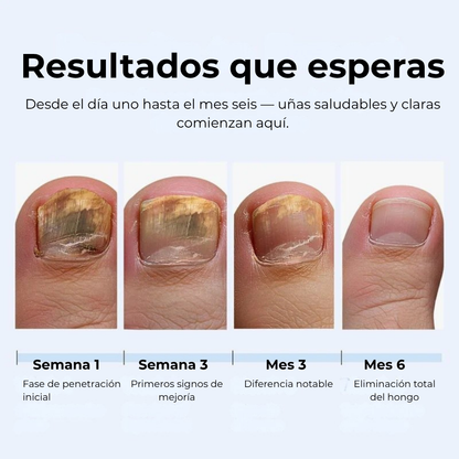 MyCureDerm Lápiz Antifúngico con Fórmula Avanzada – Contra Pie de Atleta y Hongos en Uñas