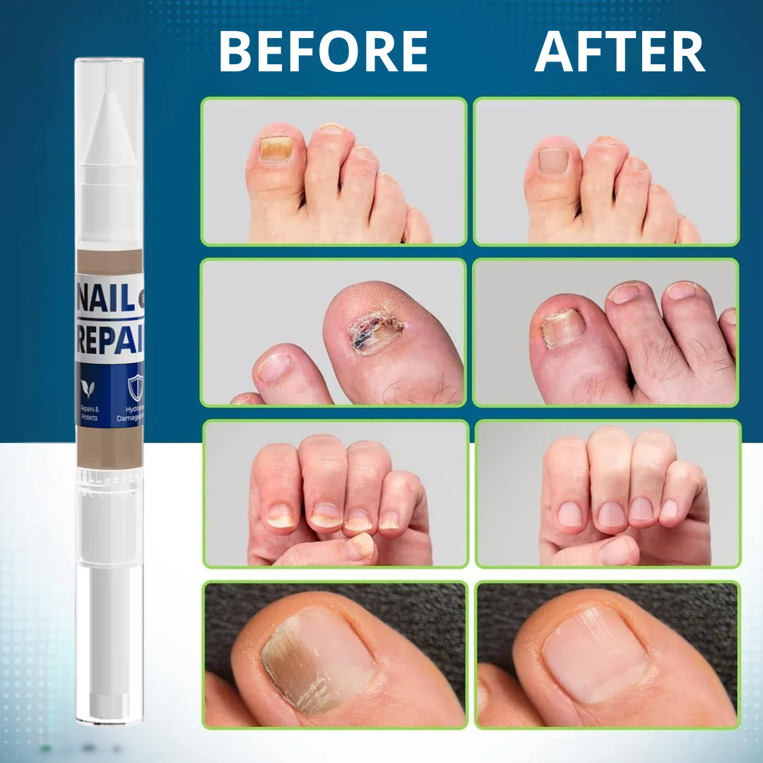 MyCurePro® Antifungal Nail Pen with Advanced Formula – Care for Damaged Nails