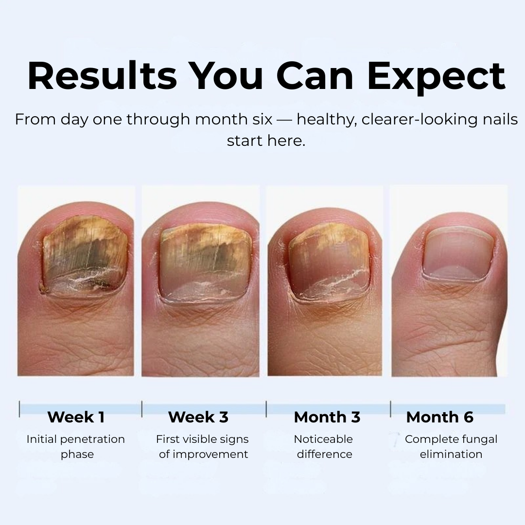 MyCurePro® Antifungal Nail Pen with Advanced Formula – Care for Damaged Nails