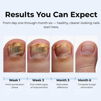 MyCurePro® Antifungal Nail Pen with Advanced Formula – Care for Damaged Nails