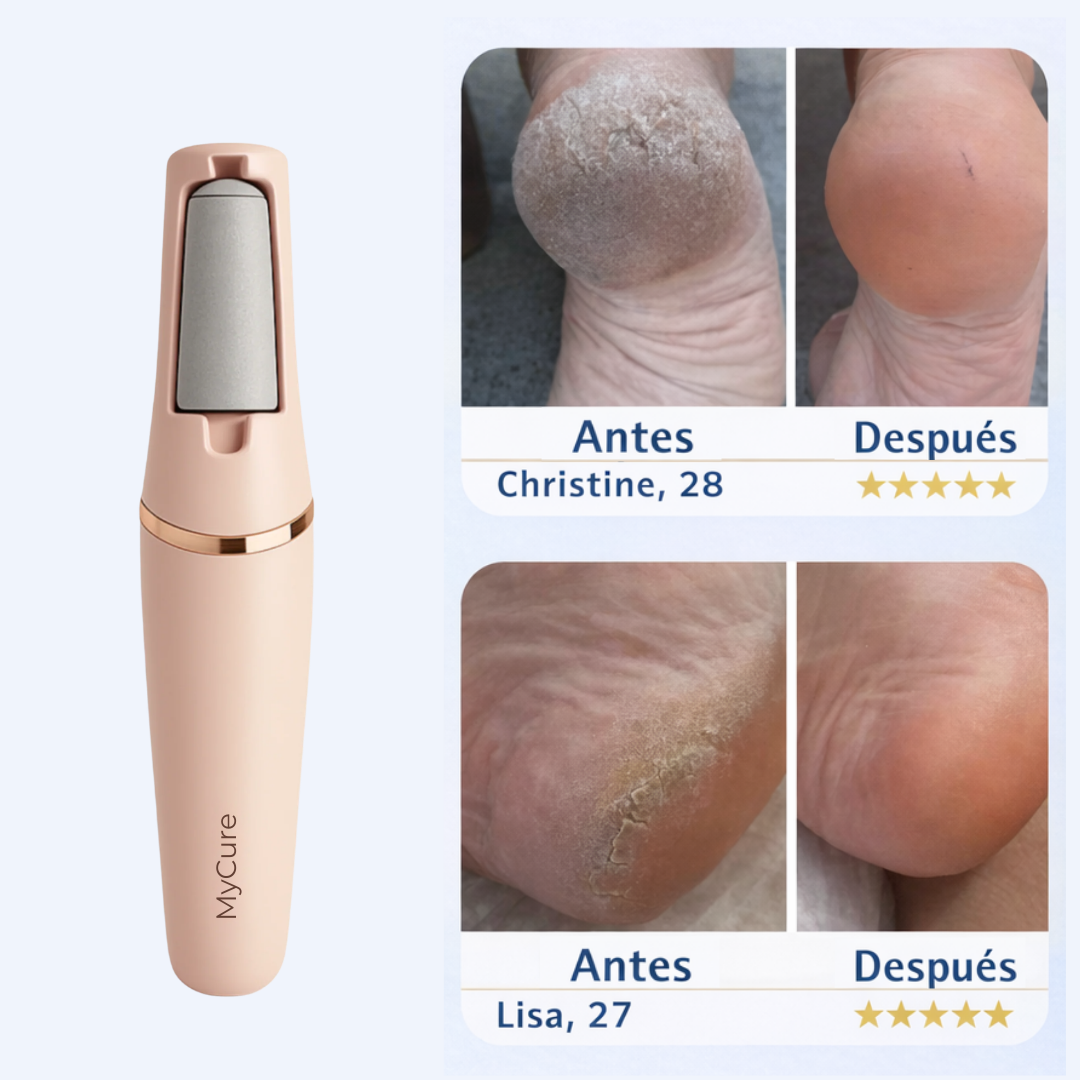 MyCure™ 2 Pro – Eliminador Profesional de Callos