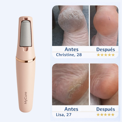 MyCure™ 2 Pro – Eliminador Profesional de Callos